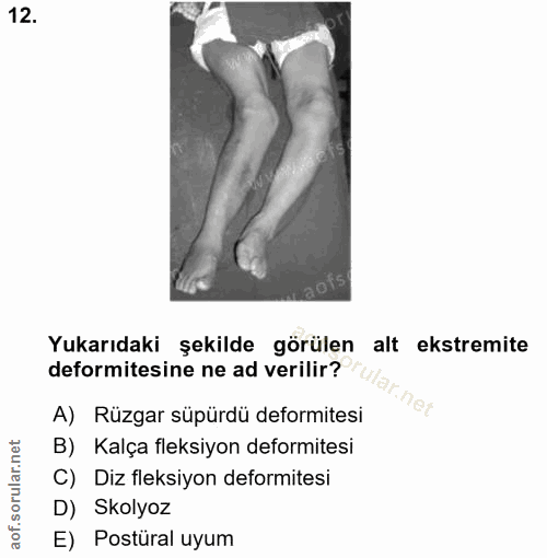 12. soru: Yukarıdaki şekilde görülen alt ekstremite deformitesine ne ad verilir? far.net A) Rüzgar süpürdü deformitesi B) Kalça…