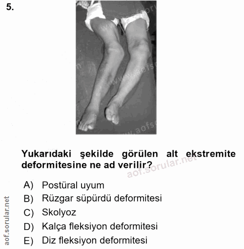 5. soru: Yukarıdaki şekilde görülen alt ekstremite deformitesine ne ad verilir? A) Postüral uyum B) Rüzgar süpürdü deformitesi…