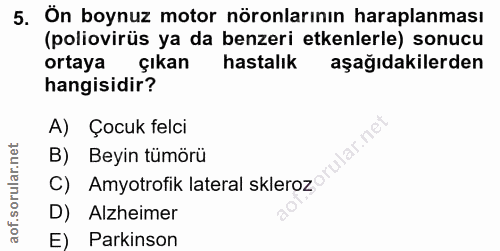 5. soru: Ön boynuz motor nöronlarının haraplanması (poliovirüs ya da benzeri etkenlerle) sonucu ortaya çıkan hastalık aşağıdak…